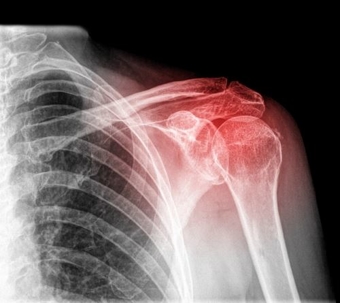 Xray of a shoulder injury